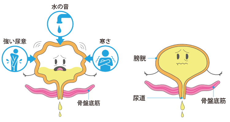 骨盤底筋が衰えている状態